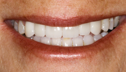 west lake hills dental austin texas_orthodontics implant and porcelain veneers_after